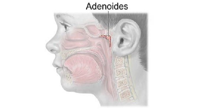 Tratamiento natural de la adenoiditis